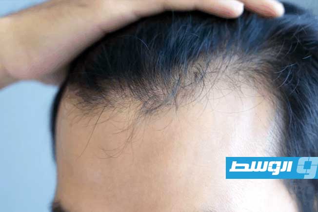 دراسة جديدة: أدوية إنقاص الوزن قد ترتبط بزيادة خطر الإصابة بـ«الثعلبة»